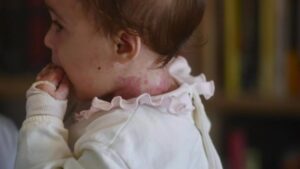 Olivia tiene 'piel de mariposa', una enfermedad rara que provoca que su piel sufra heridas y ampollas incluso con el más leve roce Miquel A. Borràs EFE